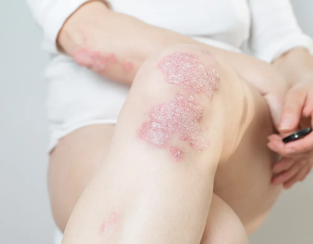 Schuppenflechte am Knie